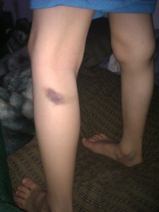 bruise